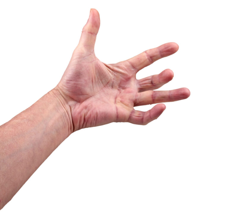 8 Natural Remedies for Dupuytren’s Contracture