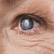 4 Natural Ways to Prevent Cataracts