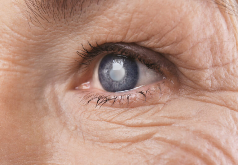 4 Natural Ways to Prevent Cataracts